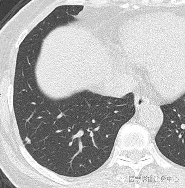 【病例】肺内小结节,估计80%的同行都没考虑这个诊断 【病例】肺内小结节,估计80%的同行都没考虑这个诊断