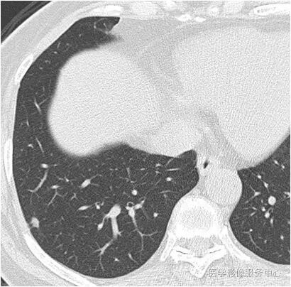 【病例】肺内小结节,估计80%的同行都没考虑这个诊断 【病例】肺内小结节,估计80%的同行都没考虑这个诊断