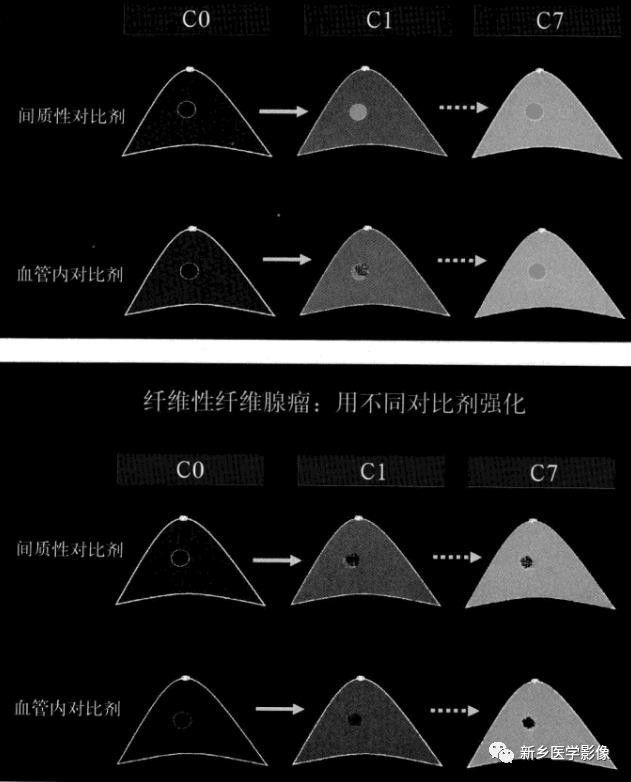 诊断乳腺的病变的主要可靠征象