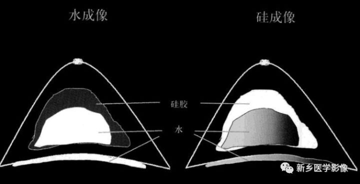 诊断乳腺的病变的主要可靠征象