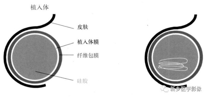 诊断乳腺的病变的主要可靠征象