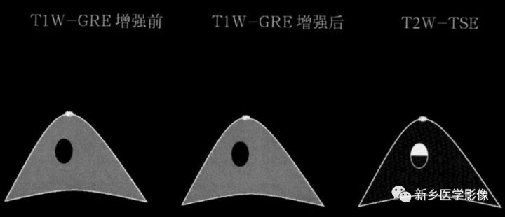 诊断乳腺的病变的主要可靠征象