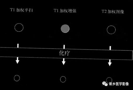 诊断乳腺的病变的主要可靠征象