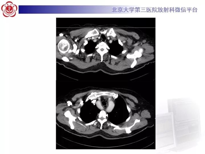 【病例】双主动脉弓畸形1例CT