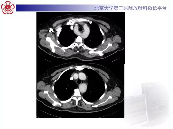 【病例】双主动脉弓畸形1例CT