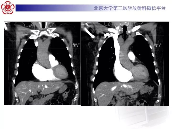 【病例】双主动脉弓畸形1例CT