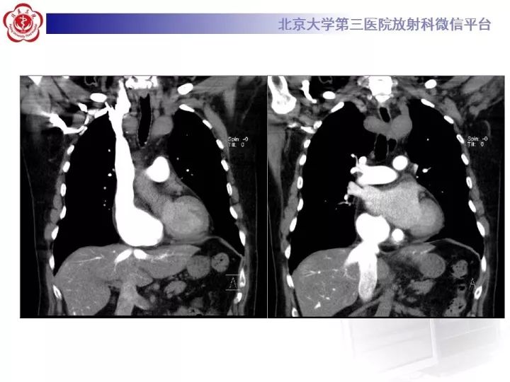 【病例】双主动脉弓畸形1例CT