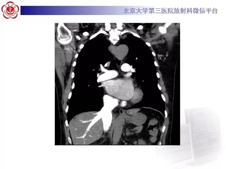 【病例】双主动脉弓畸形1例CT