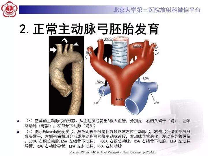 【病例】双主动脉弓畸形1例CT
