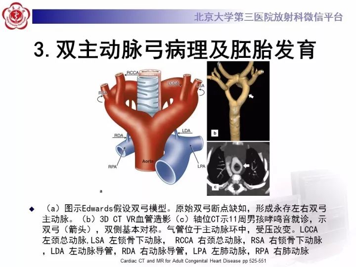 【病例】双主动脉弓畸形1例CT