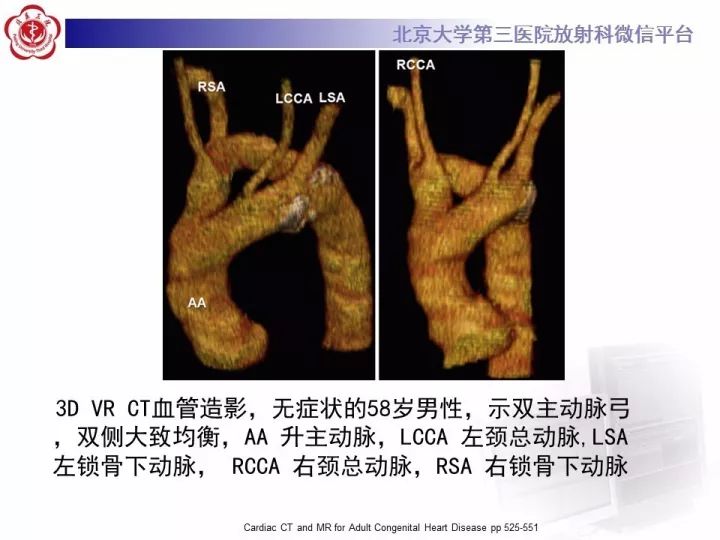 【病例】双主动脉弓畸形1例CT