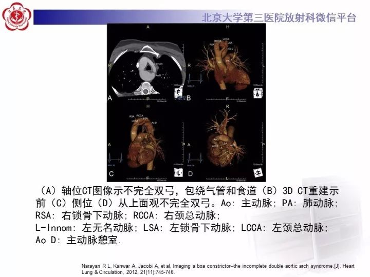 【病例】双主动脉弓畸形1例CT