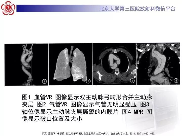 【病例】双主动脉弓畸形1例CT