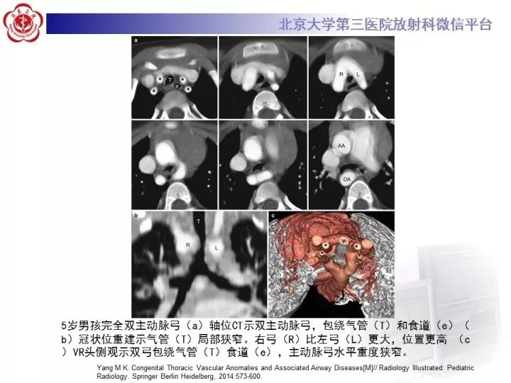 【病例】双主动脉弓畸形1例CT