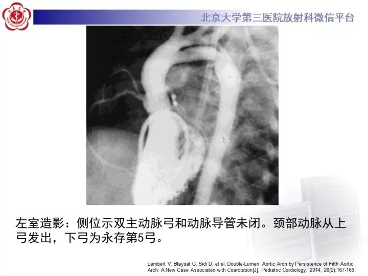 【病例】双主动脉弓畸形1例CT