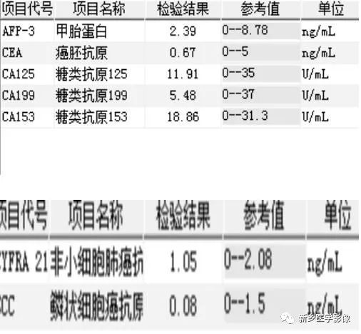【病例】肺动脉静脉畸形1例CT