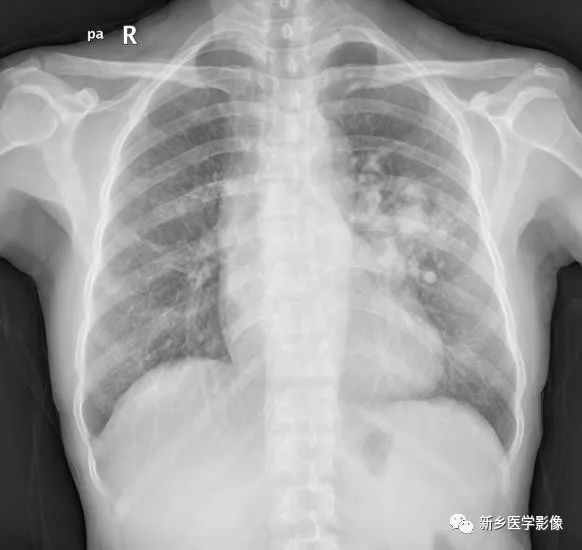 【病例】肺动脉静脉畸形1例CT