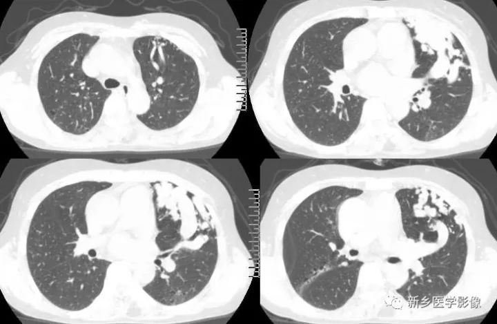 【病例】肺动脉静脉畸形1例CT