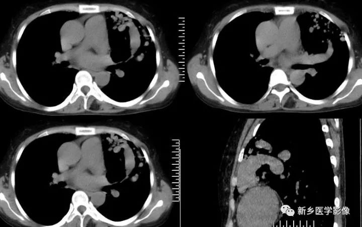 【病例】肺动脉静脉畸形1例CT