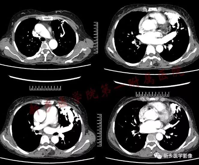 【病例】肺动脉静脉畸形1例CT