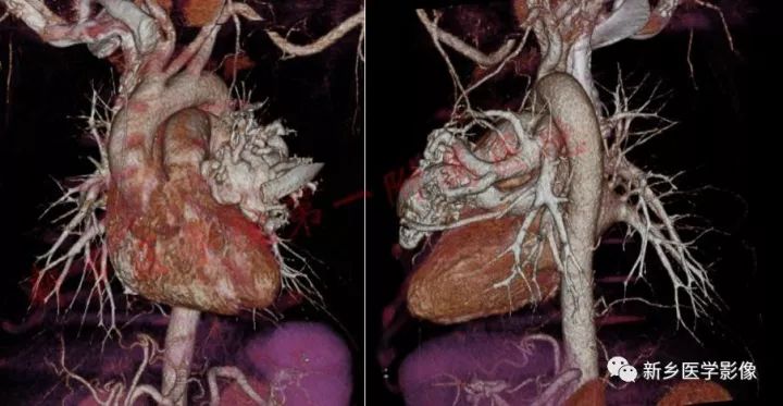 【病例】肺动脉静脉畸形1例CT