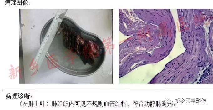 【病例】肺动脉静脉畸形1例CT