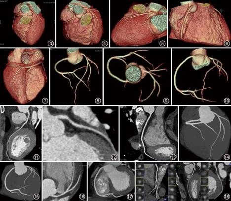 心脏冠状动脉CT血管成像技术规范化应用中国指南精选