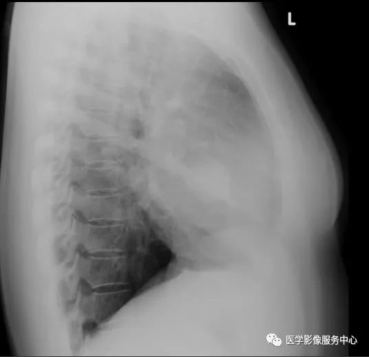 【病例】肺曲菌球1例X线CT