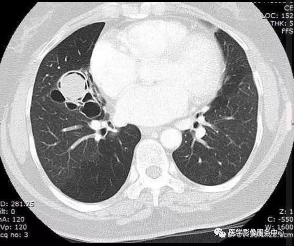 【病例】肺曲菌球1例X线CT