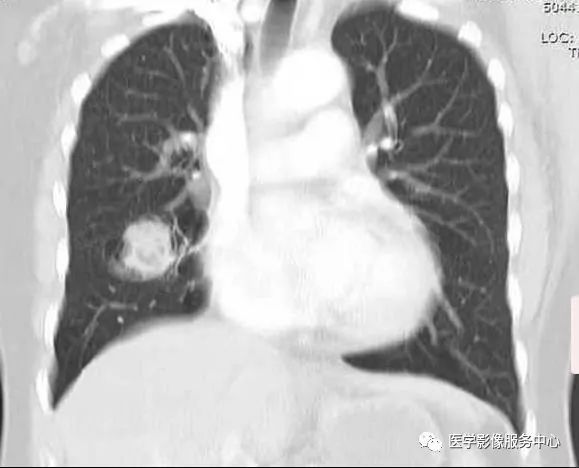 【病例】肺曲菌球1例X线CT