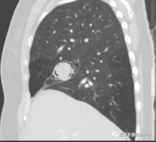 【病例】肺曲菌球1例X线CT