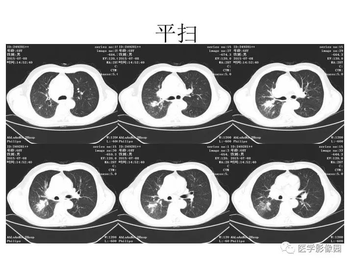 【病例】右肺上叶小细胞性肺癌1例CT影像表现