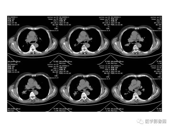 【病例】右肺上叶小细胞性肺癌1例CT影像表现