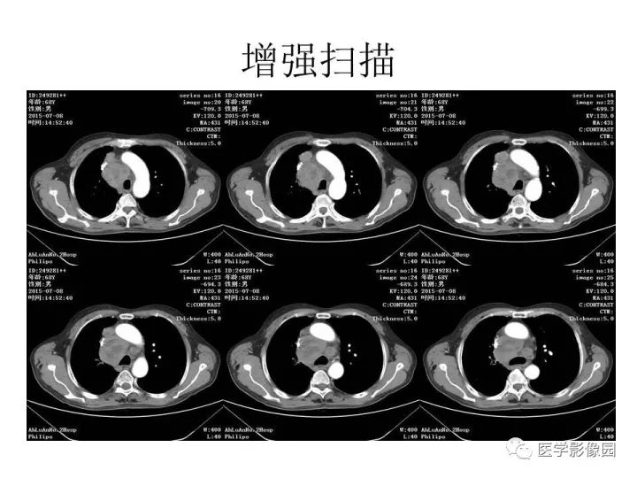 【病例】右肺上叶小细胞性肺癌1例CT影像表现