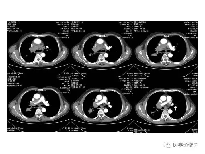 【病例】右肺上叶小细胞性肺癌1例CT影像表现