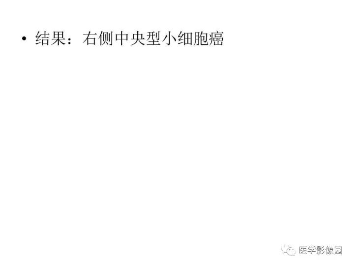 【病例】右肺上叶小细胞性肺癌1例CT影像表现
