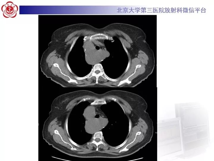 【病例】右位主动脉弓合并迷走左锁骨下动脉1例CT