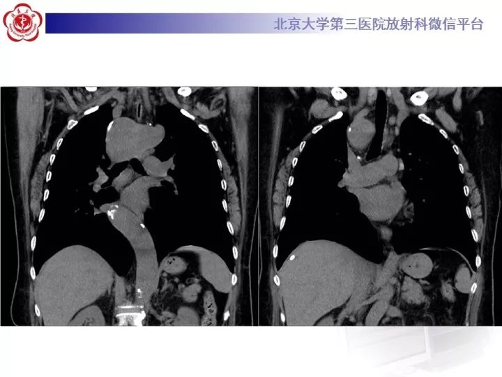 【病例】右位主动脉弓合并迷走左锁骨下动脉1例CT