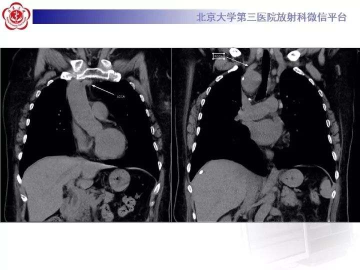 【病例】右位主动脉弓合并迷走左锁骨下动脉1例CT