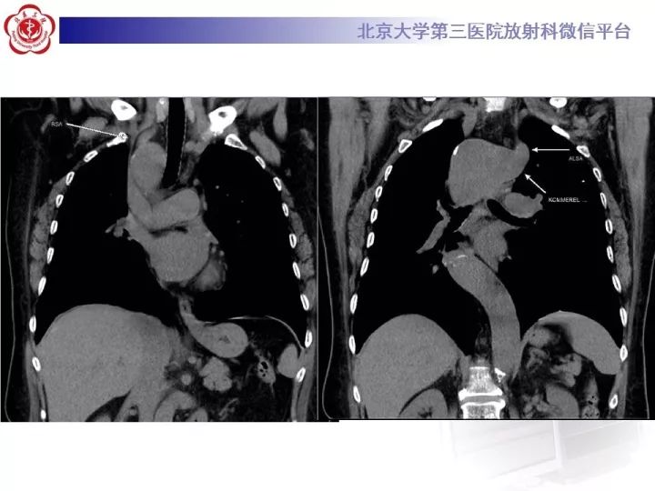 【病例】右位主动脉弓合并迷走左锁骨下动脉1例CT