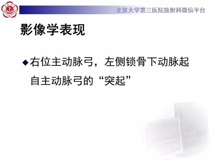 【病例】右位主动脉弓合并迷走左锁骨下动脉1例CT