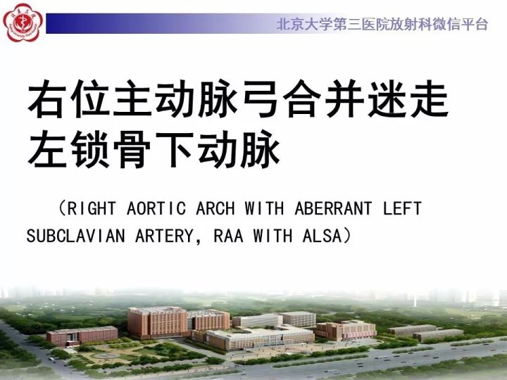 【病例】右位主动脉弓合并迷走左锁骨下动脉1例CT