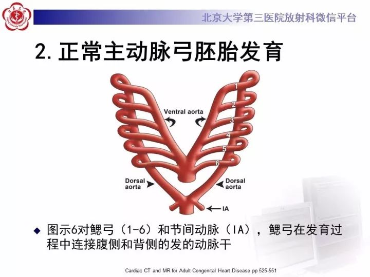【病例】右位主动脉弓合并迷走左锁骨下动脉1例CT