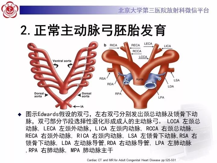【病例】右位主动脉弓合并迷走左锁骨下动脉1例CT