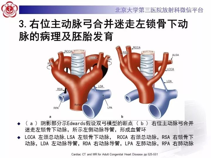 【病例】右位主动脉弓合并迷走左锁骨下动脉1例CT