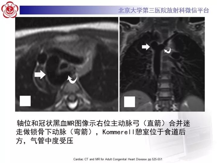 【病例】右位主动脉弓合并迷走左锁骨下动脉1例CT