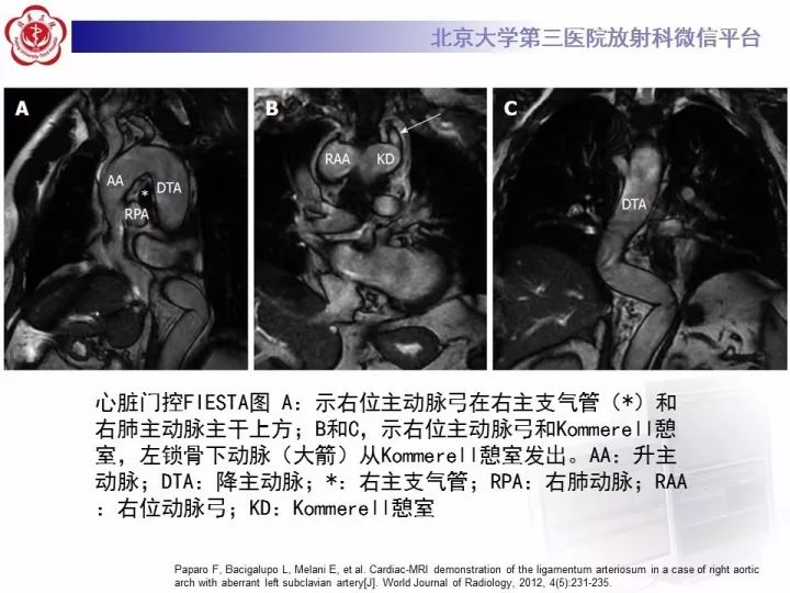 【病例】右位主动脉弓合并迷走左锁骨下动脉1例CT