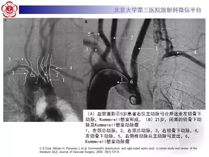 【病例】右位主动脉弓合并迷走左锁骨下动脉1例CT
