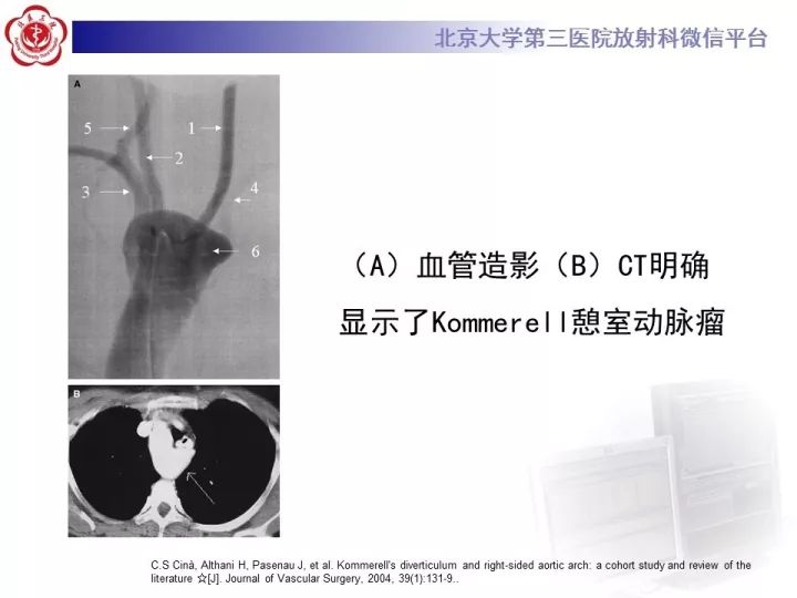 【病例】右位主动脉弓合并迷走左锁骨下动脉1例CT