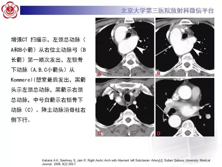 【病例】右位主动脉弓合并迷走左锁骨下动脉1例CT